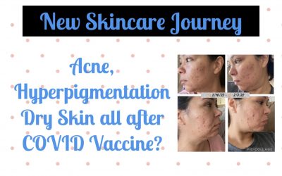 Acne, Hyperpigmentation Dry Skin, Hair Fallout all after COVID Vaccine?
